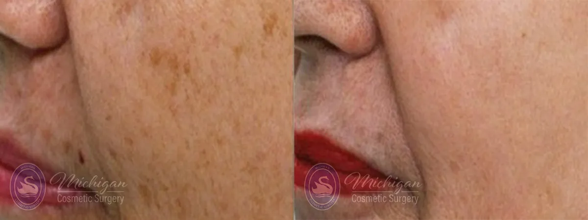 Michigan Cosmetic Surgery Southfield Pigment P