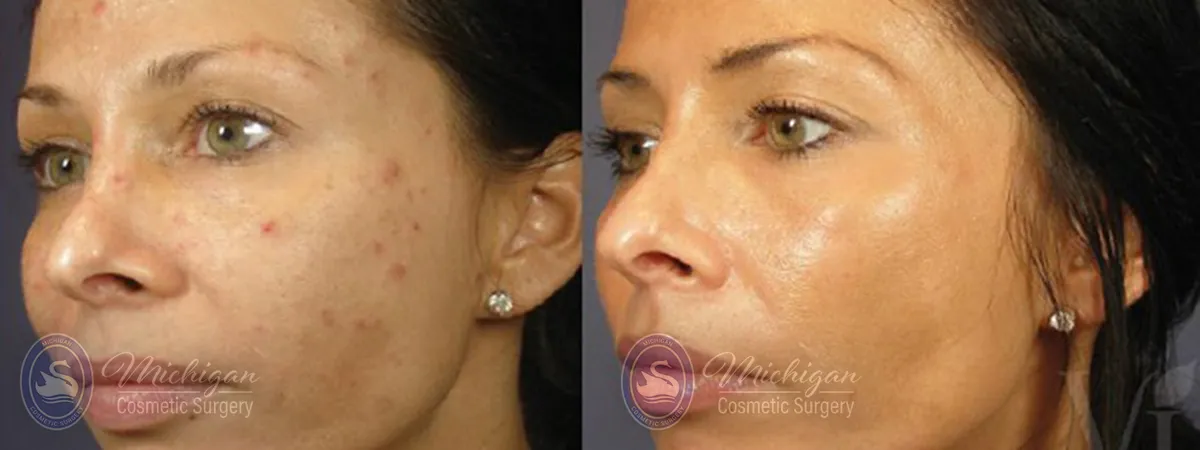 acne removal before and after image