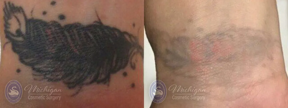 before after laser tattoo removal