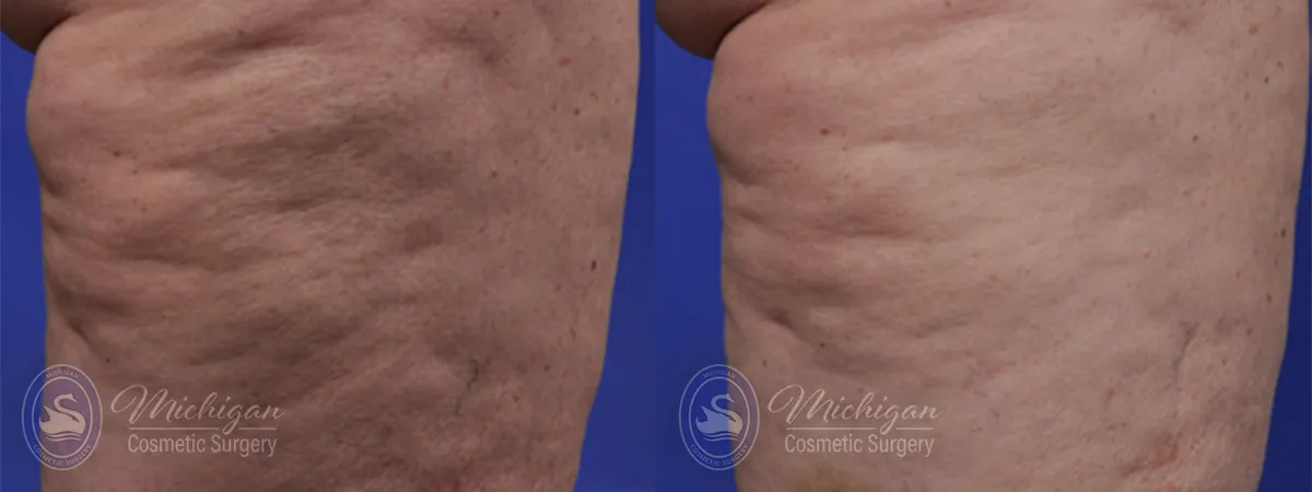cellulite before after image
