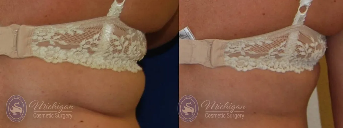 coolsculpting before and after
