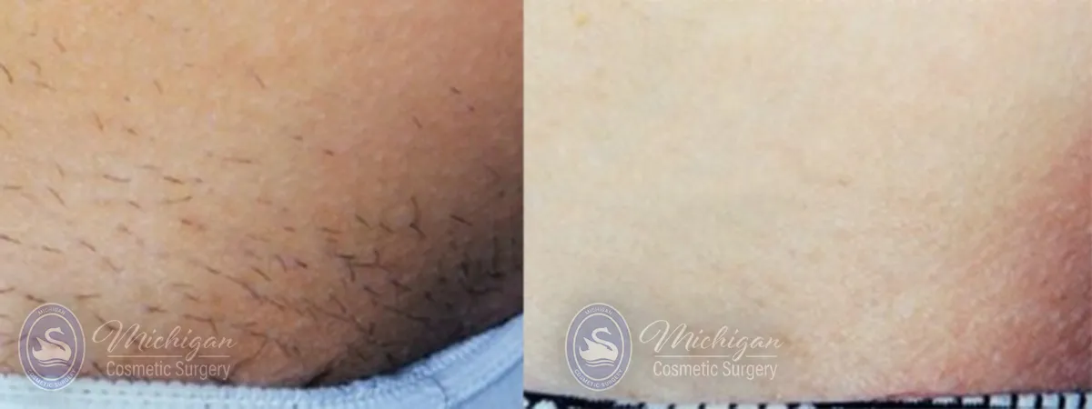 laser hair removal before after