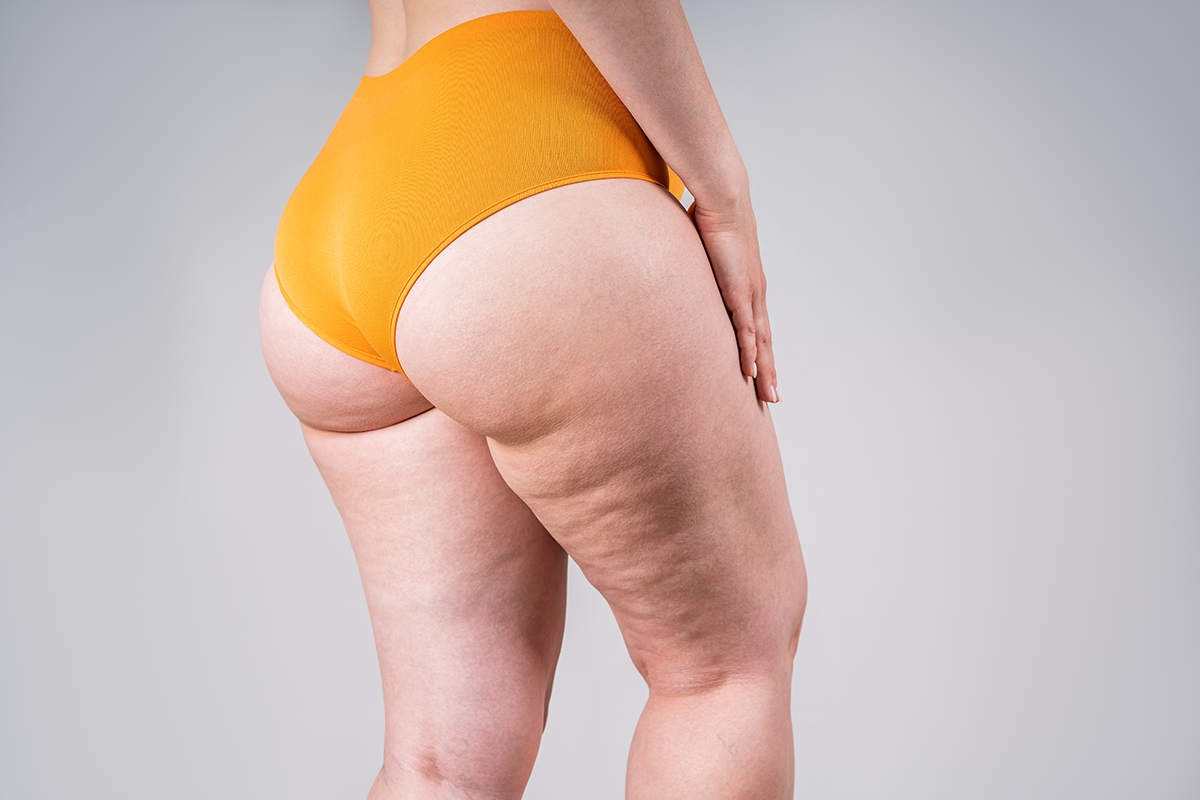 obese female body with cellulite