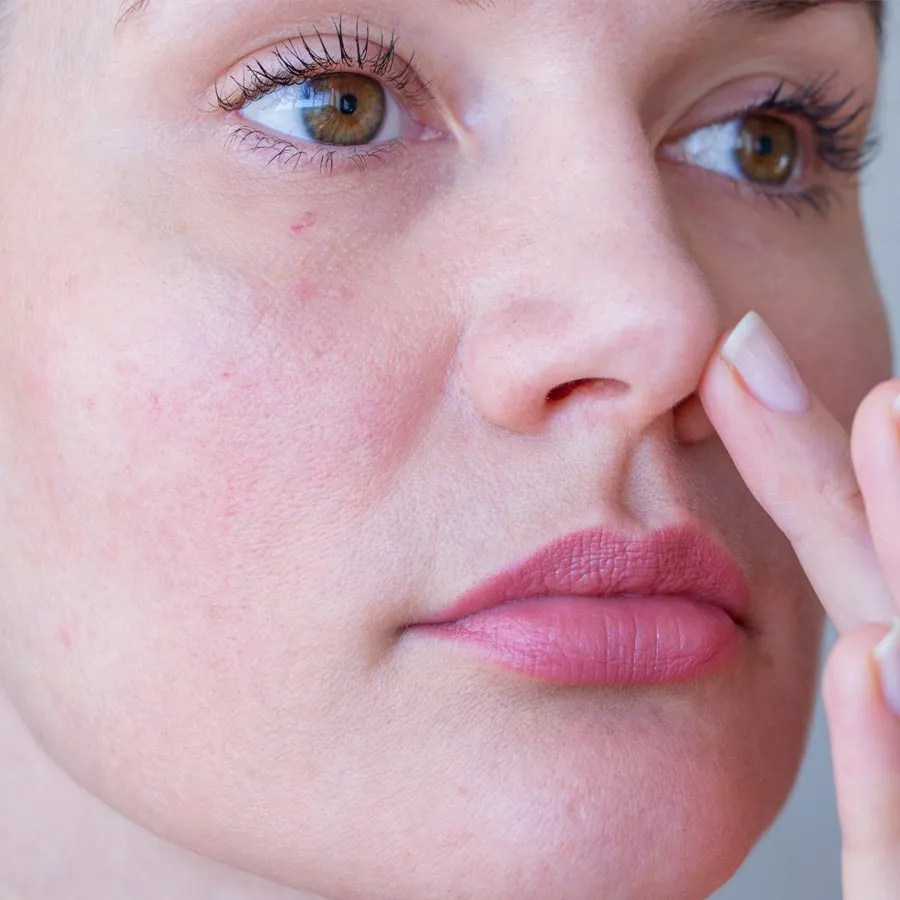 Young woman with rosacea problem on face