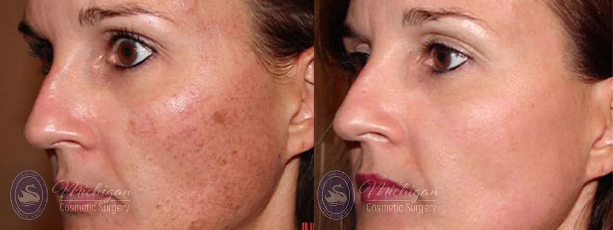 redness before and after image