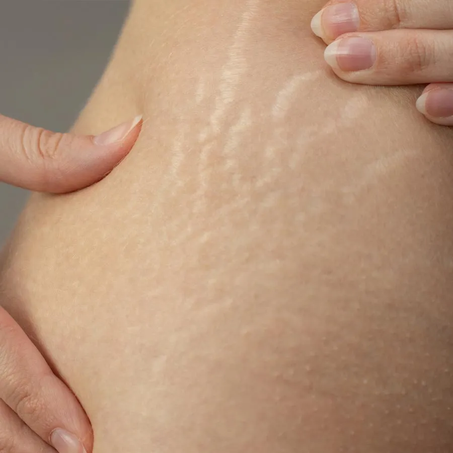 Young woman showing stretch marks on her body.