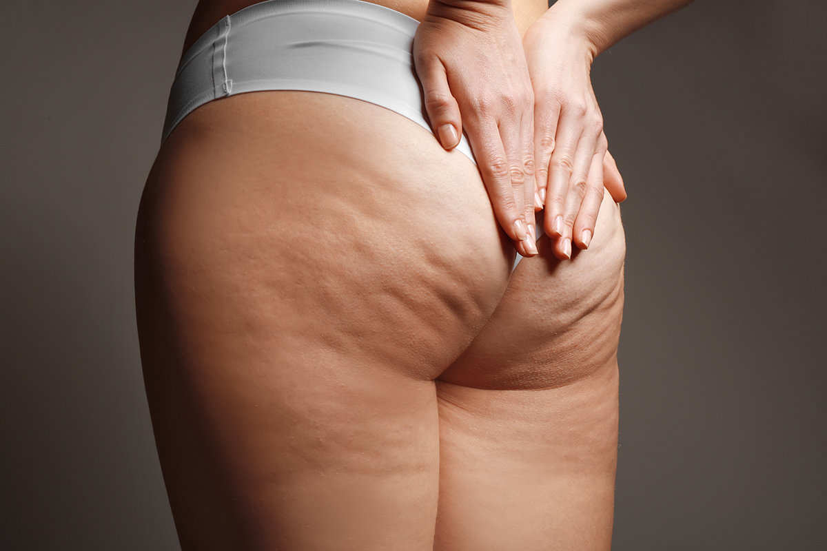 woman with cellulite problem