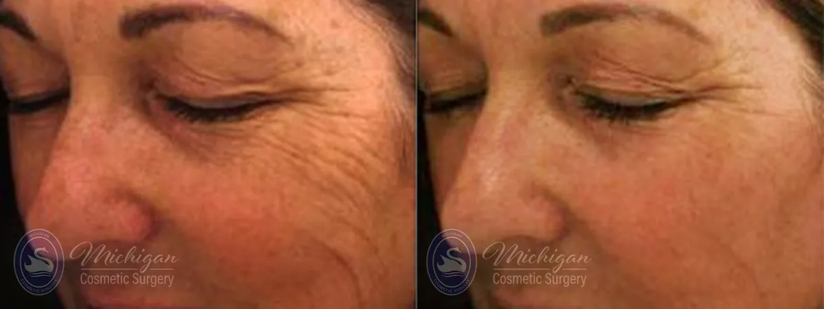 wrinkle reduction before and after image