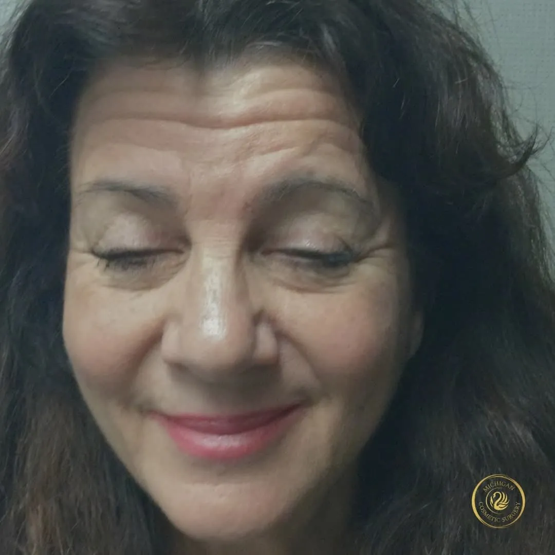 botox before photo by michigan cosmetic surgery in southfield mi