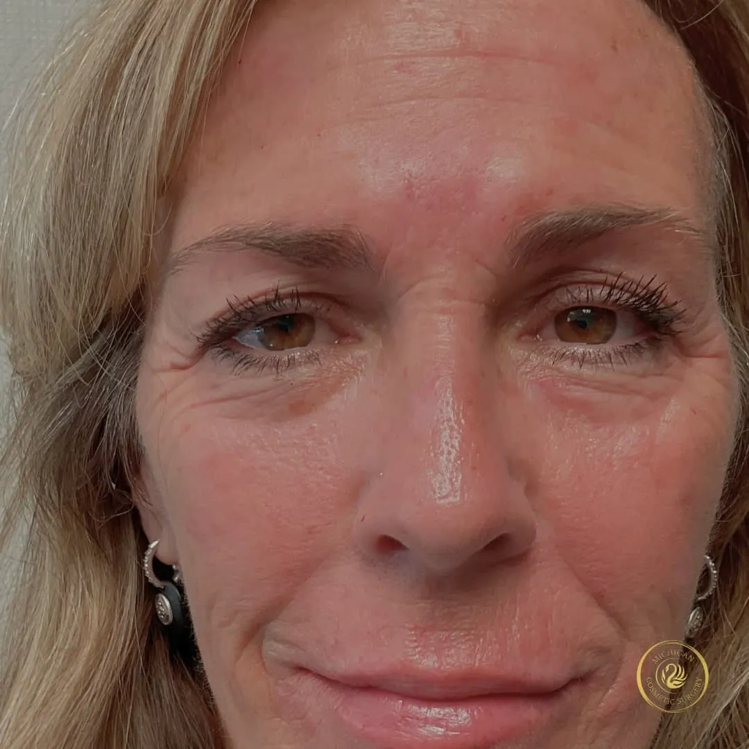 botox after photo by michigan cosmetic surgery in southfield mi