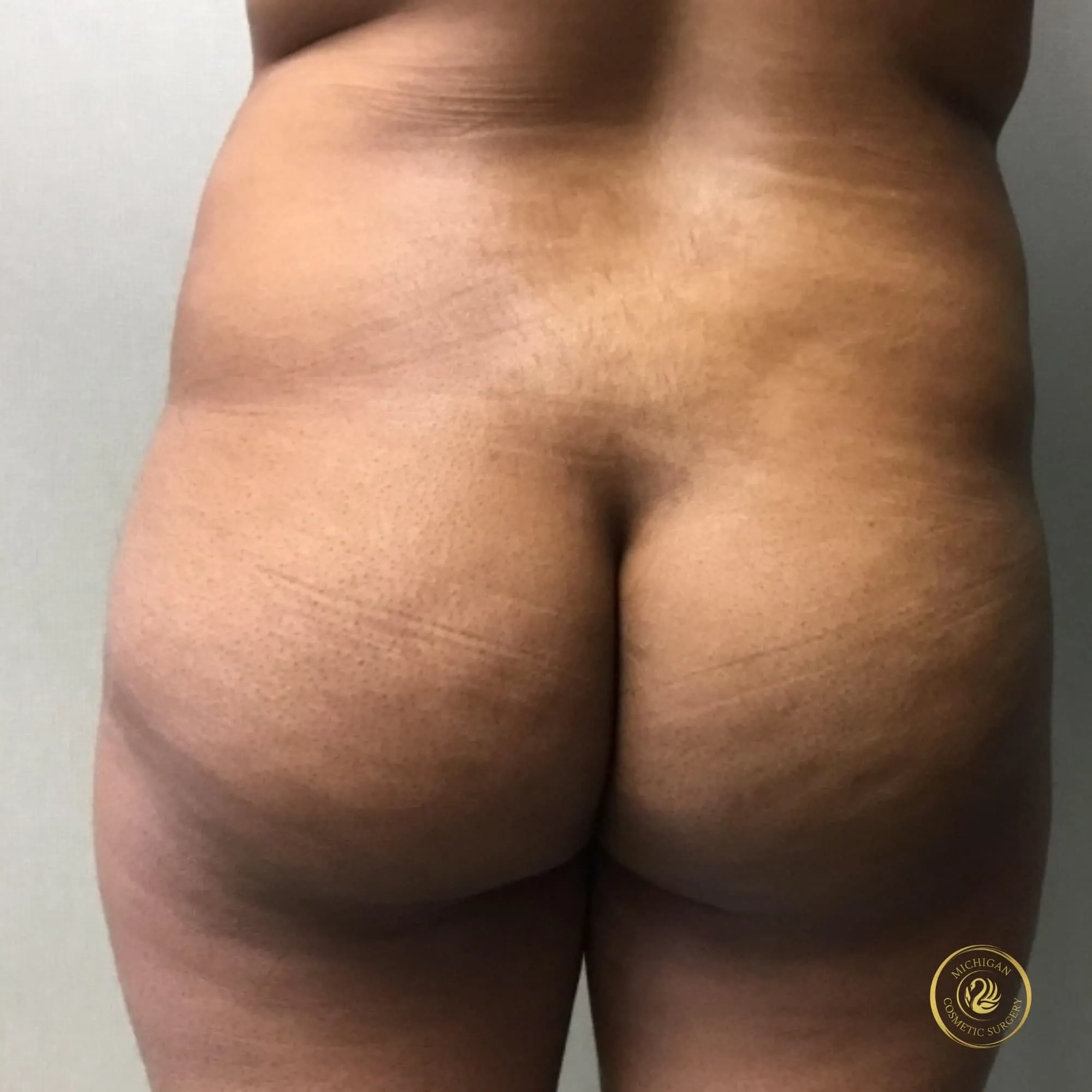 brazilian butt lift before photo by michigan cosmetic surgery in southfield mi