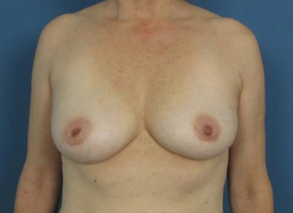 breast asymmetry after photo by michigan cosmetic surgery in southfield mi