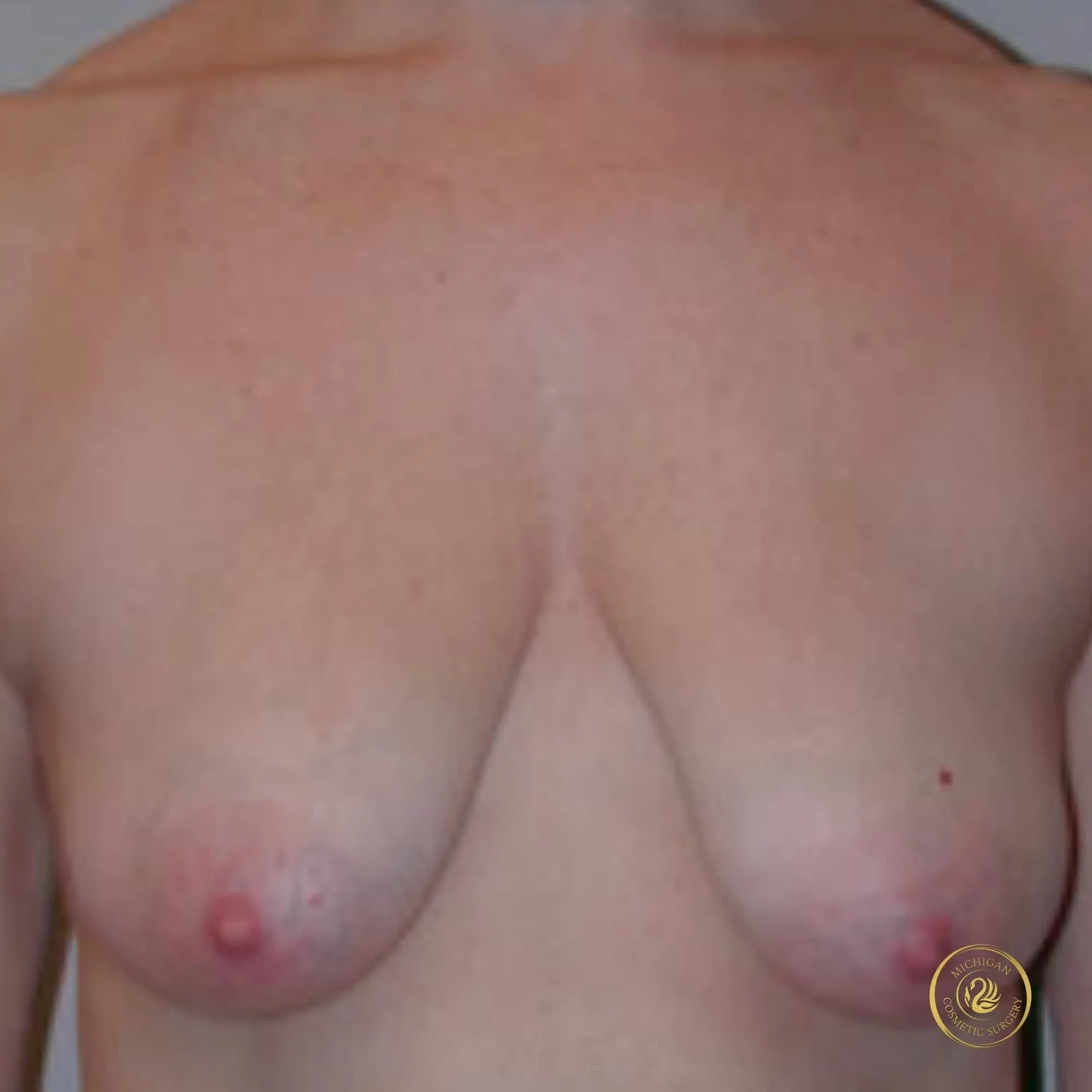 breast lift before photo by michigan cosmetic surgery in southfield mi