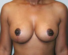 breast reduction after photo by michigan cosmetic surgery in southfield mi