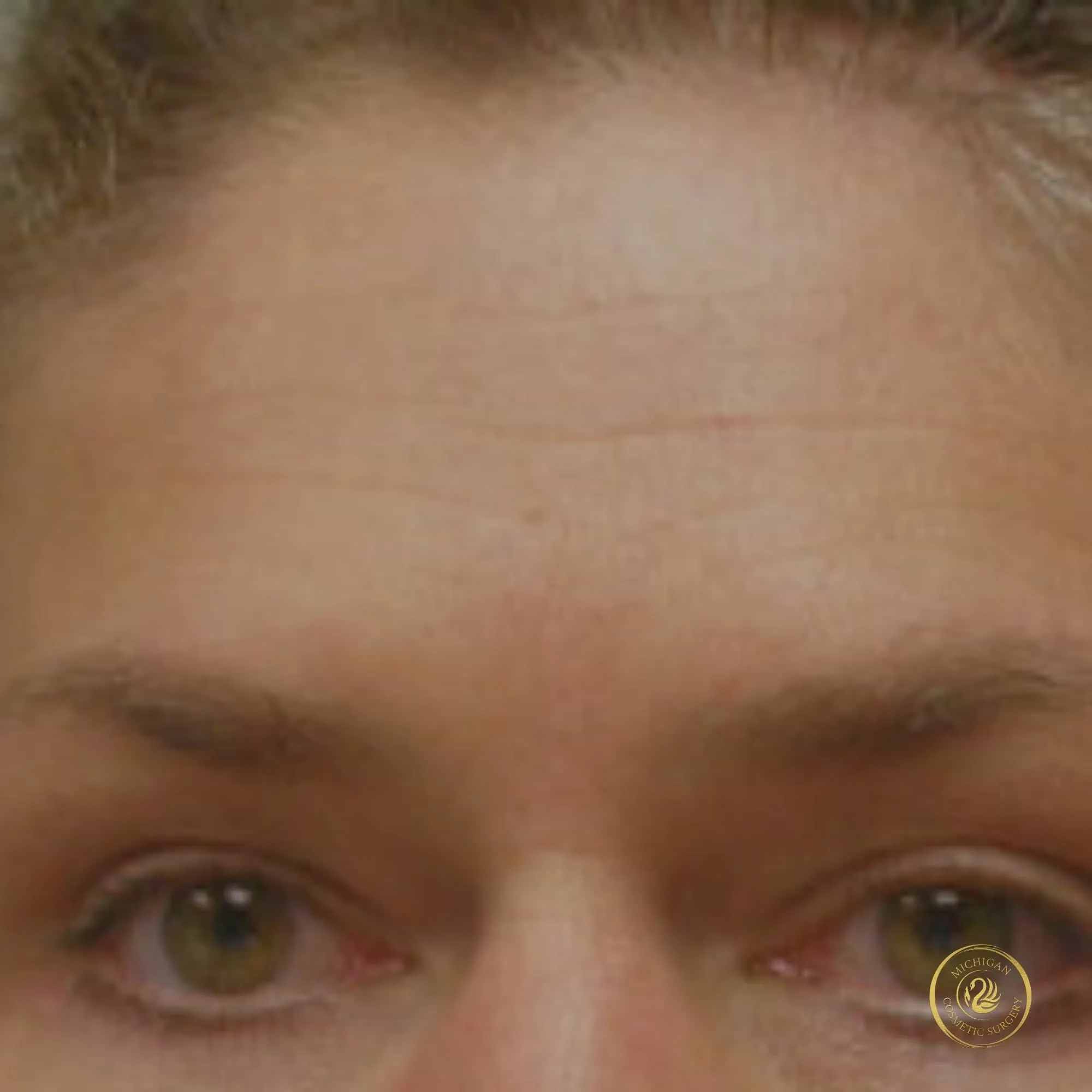 brow lift after photo by michigan cosmetic surgery in southfield mi