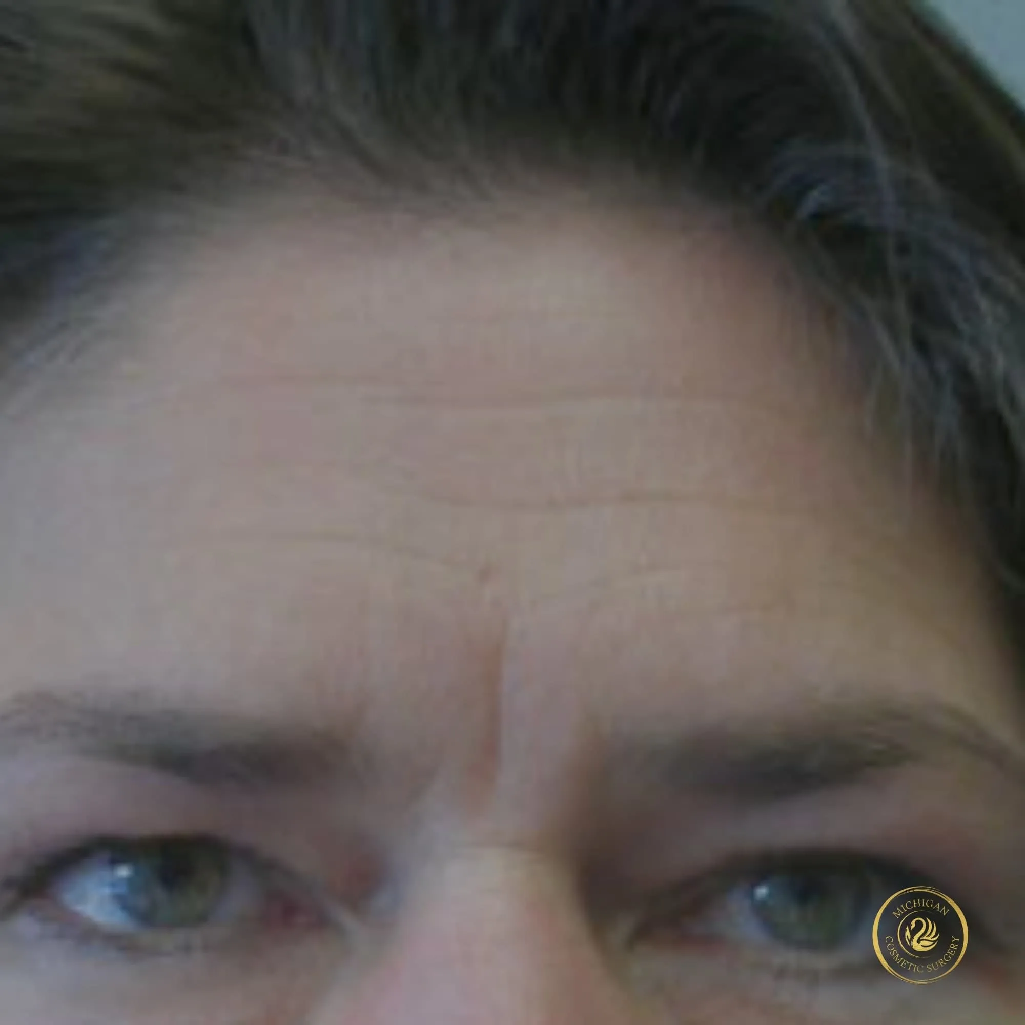 brow lift before photo by michigan cosmetic surgery in southfield mi