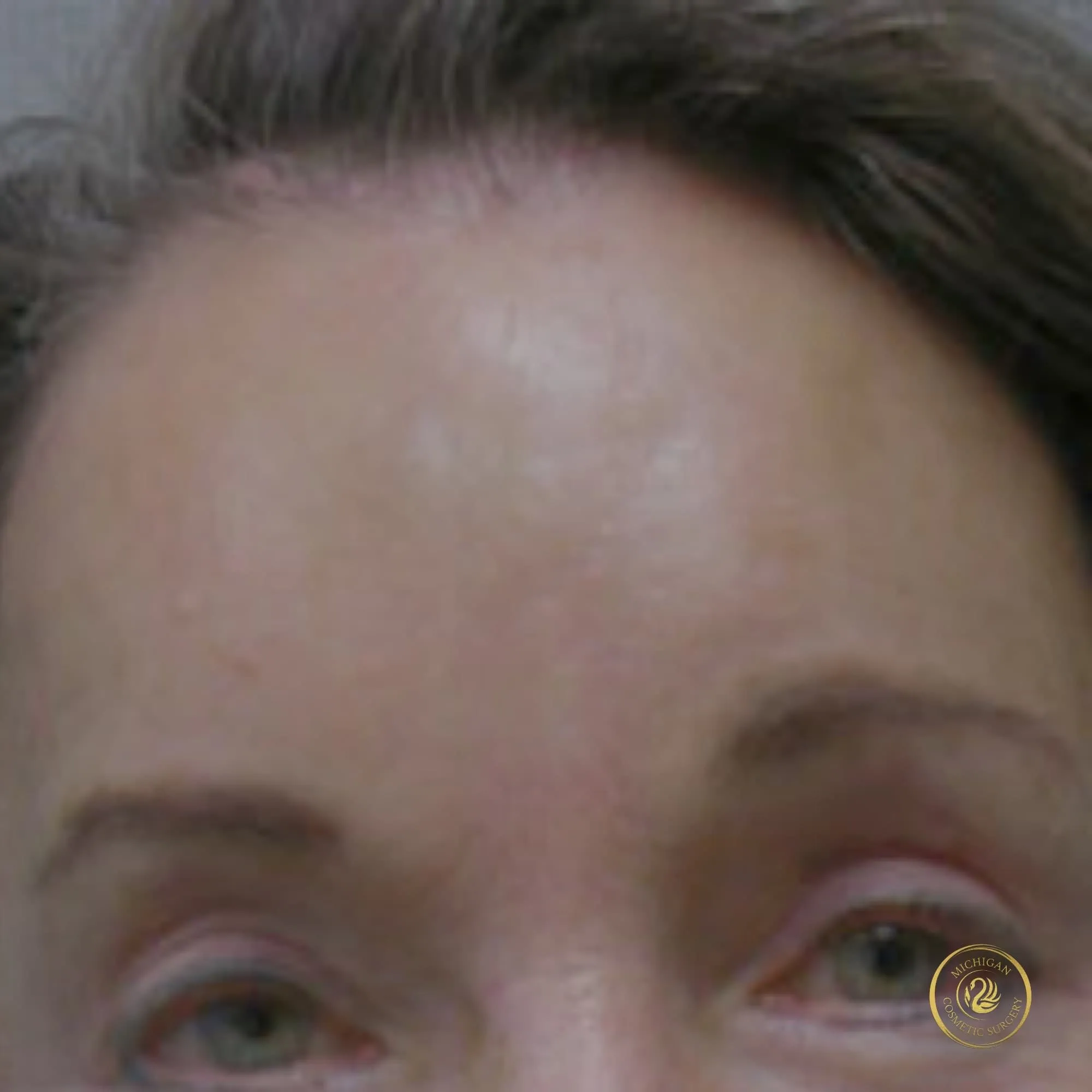 brow lift after photo by michigan cosmetic surgery in southfield mi