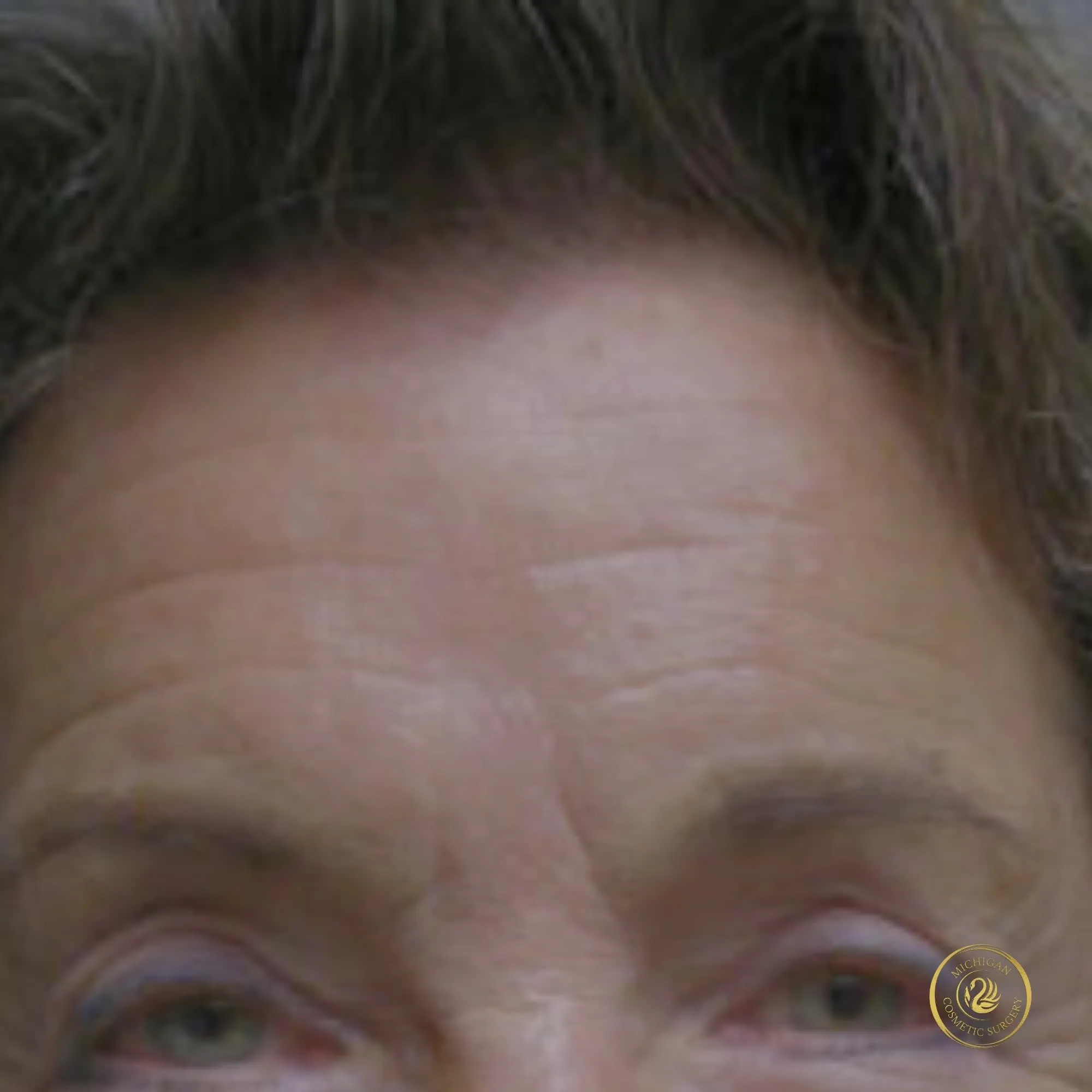 brow lift before photo by michigan cosmetic surgery in southfield mi
