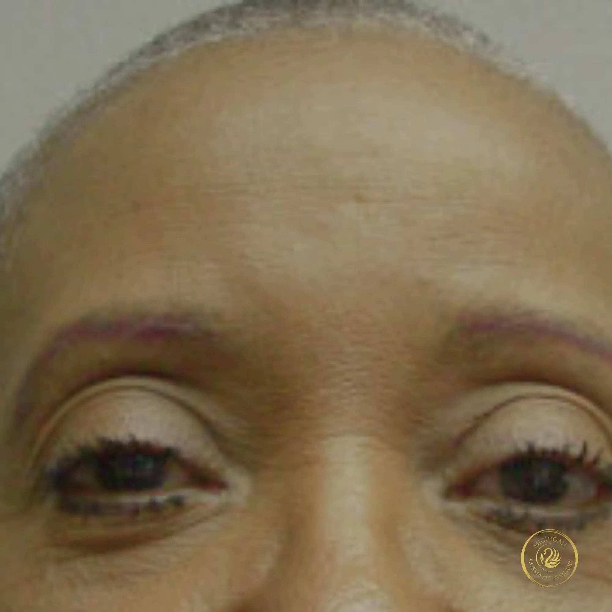 brow lift after photo by michigan cosmetic surgery in southfield mi