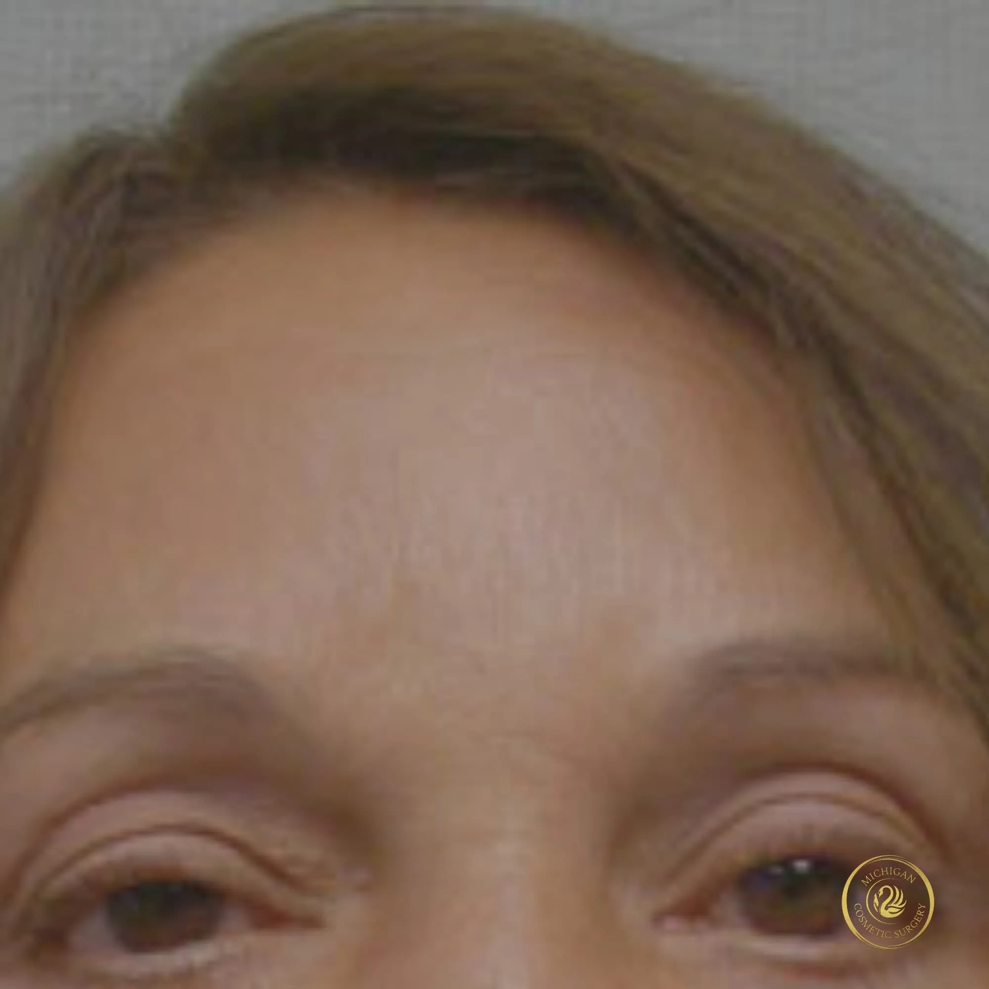 brow lift after photo by michigan cosmetic surgery in southfield mi