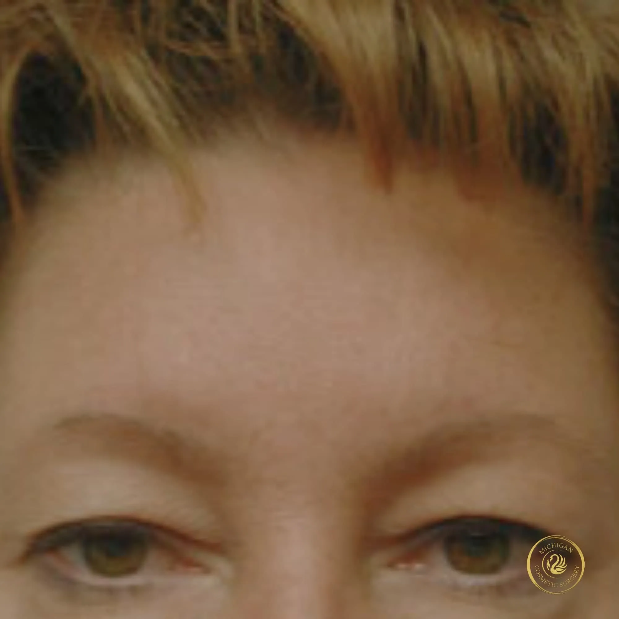 brow lift before photo by michigan cosmetic surgery in southfield mi