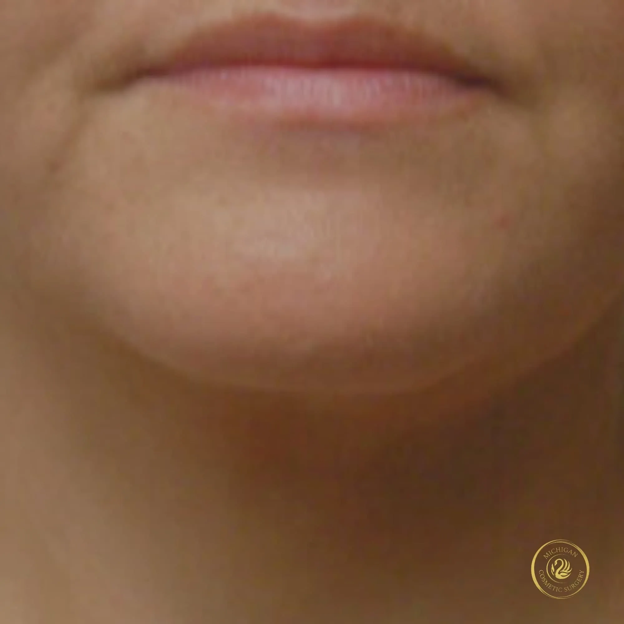 chin liposuction after photo by michigan cosmetic surgery in southfield mi
