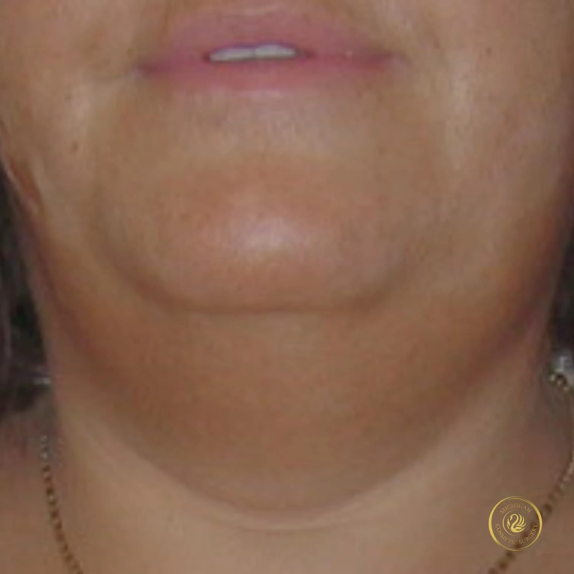 chin liposuction before photo by michigan cosmetic surgery in southfield mi
