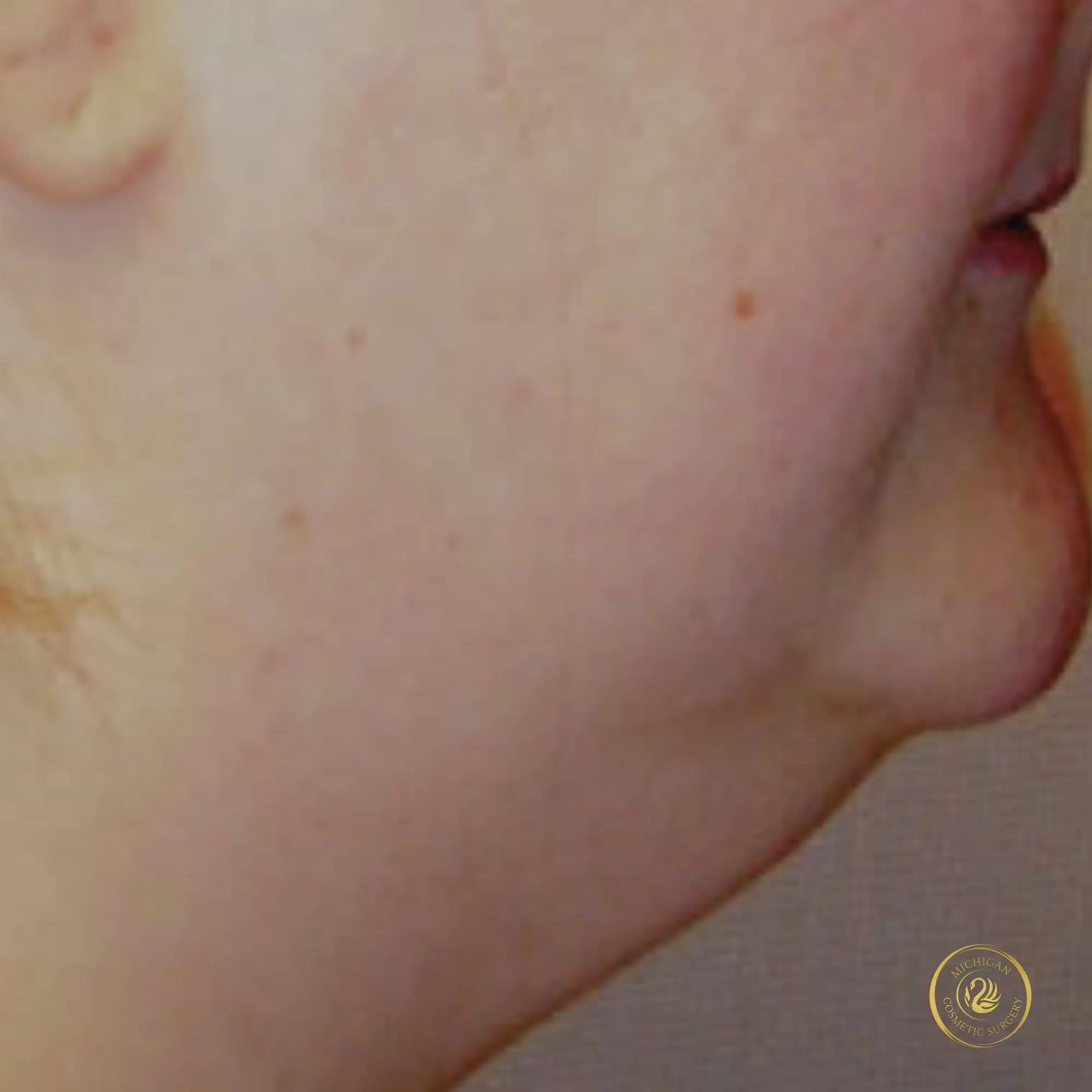chin liposuction before photo by michigan cosmetic surgery in southfield mi