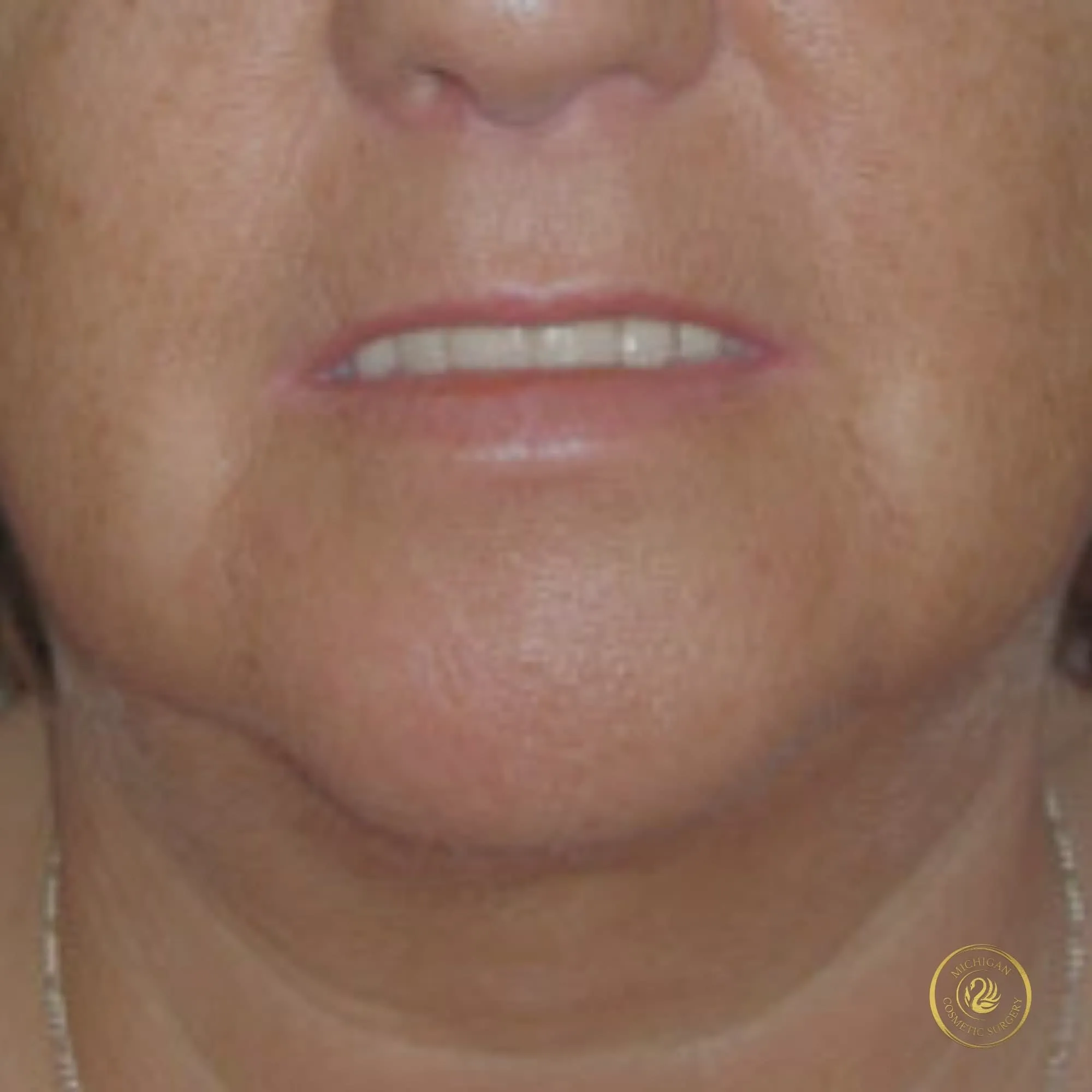 chin liposuction after photo by michigan cosmetic surgery in southfield mi