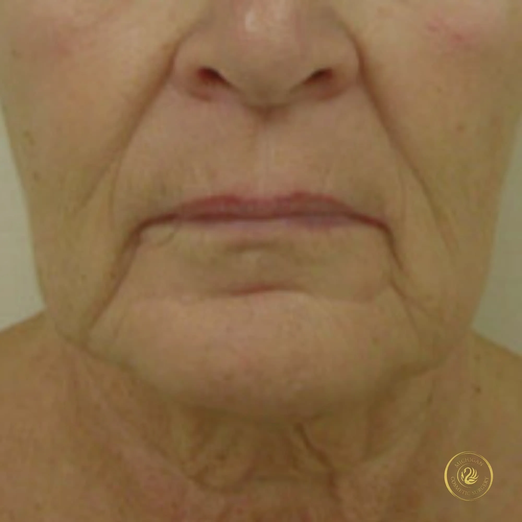 facelift before photo by michigan cosmetic surgery in southfield mi