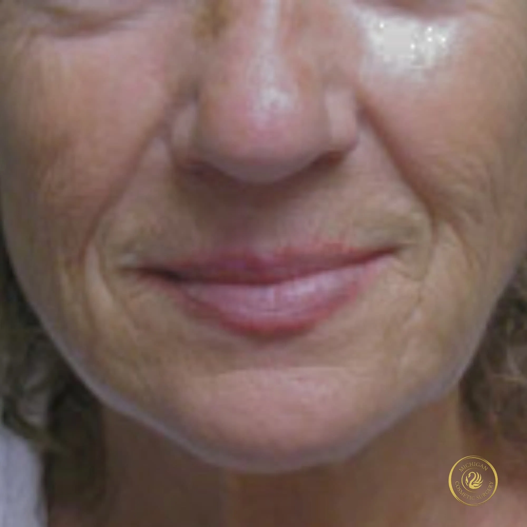 facelift before photo by michigan cosmetic surgery in southfield mi