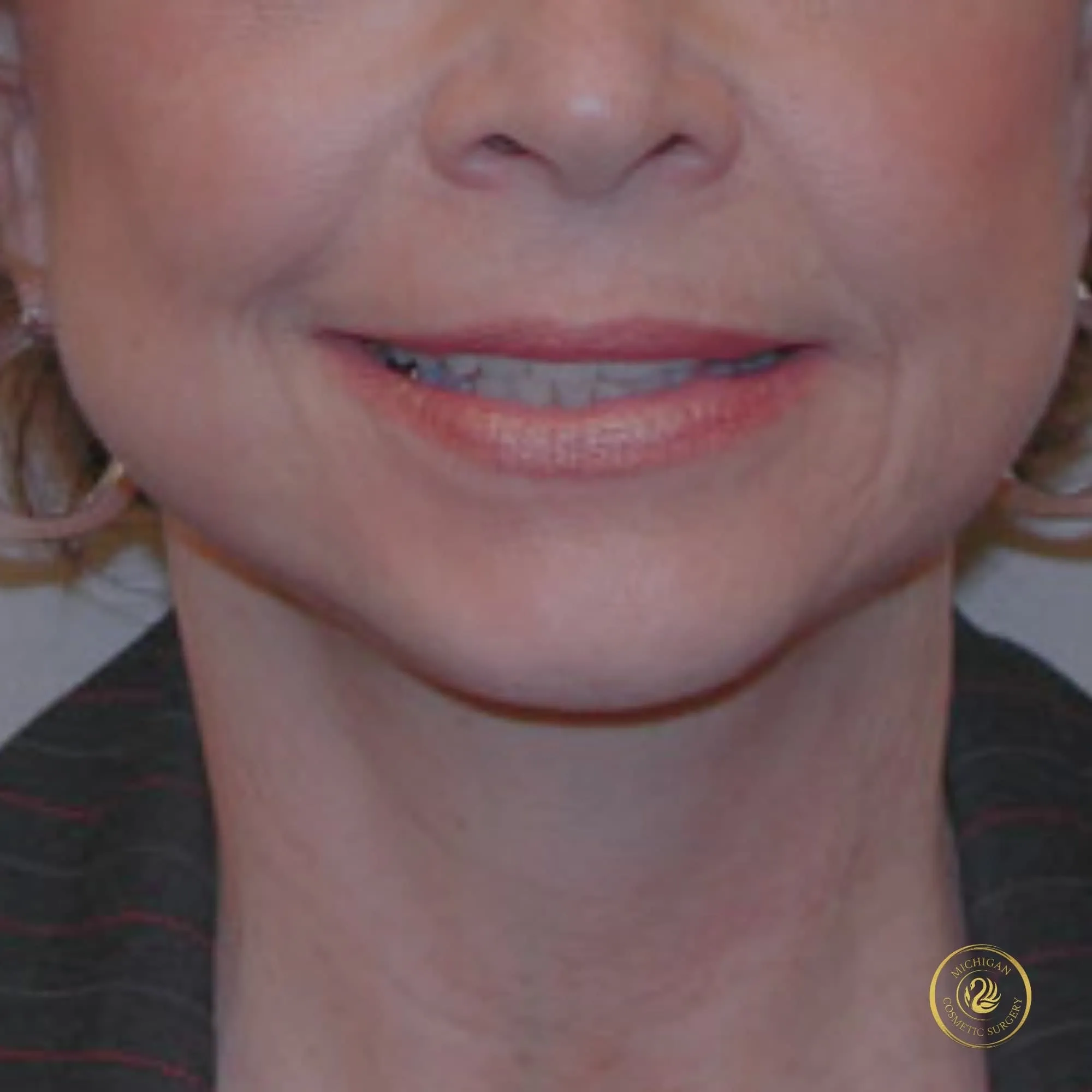 facelift after photo by michigan cosmetic surgery in southfield mi