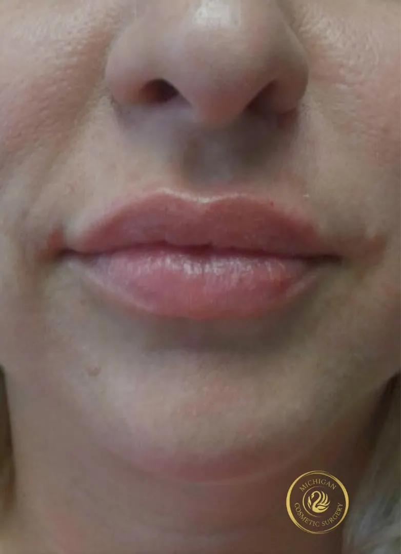 filler after photo by michigan cosmetic surgery in southfield mi