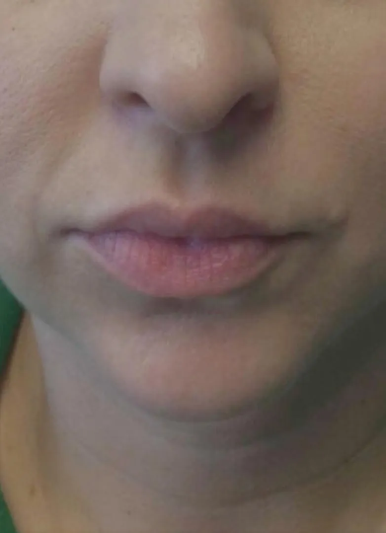 filler before photo by michigan cosmetic surgery in southfield mi
