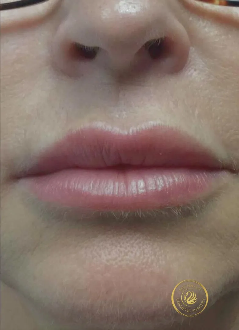 filler after photo by michigan cosmetic surgery in southfield mi