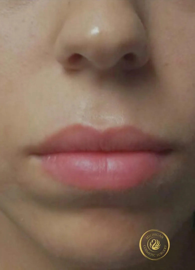 filler after photo by michigan cosmetic surgery in southfield mi
