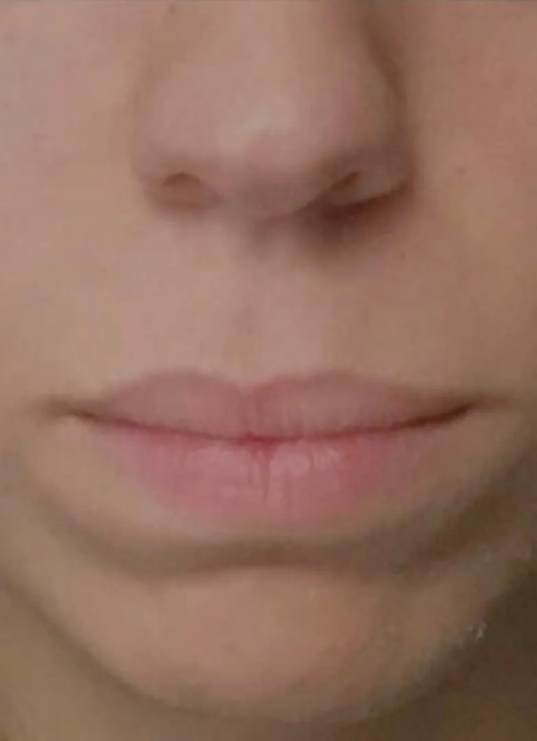 filler before photo by michigan cosmetic surgery in southfield mi