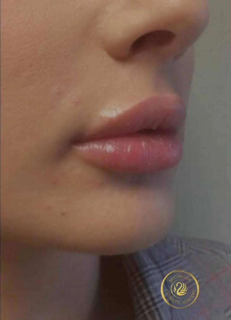 filler after photo by michigan cosmetic surgery in southfield mi
