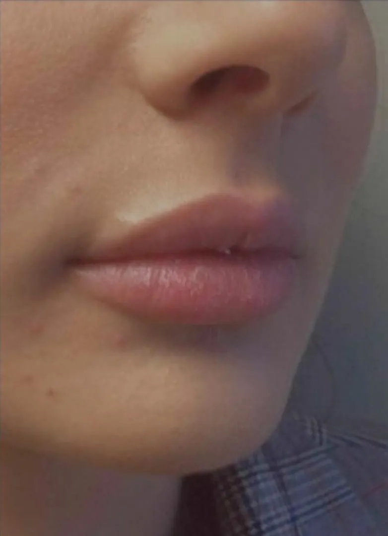 filler before photo by michigan cosmetic surgery in southfield mi