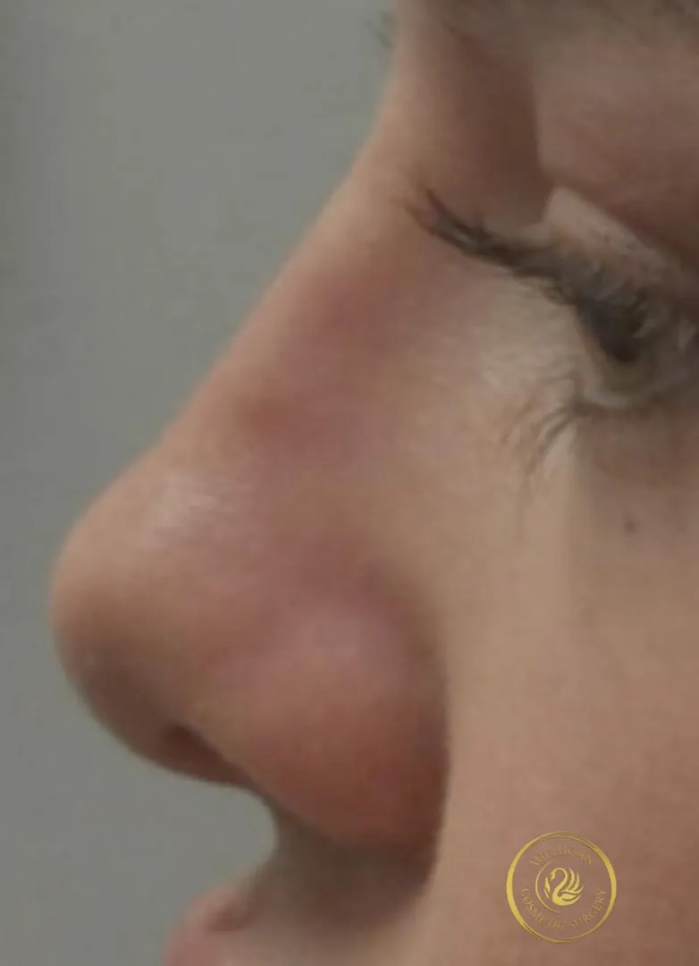 filler after photo by michigan cosmetic surgery in southfield mi