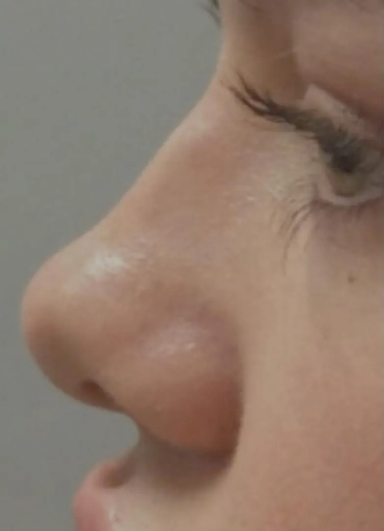 filler before photo by michigan cosmetic surgery in southfield mi