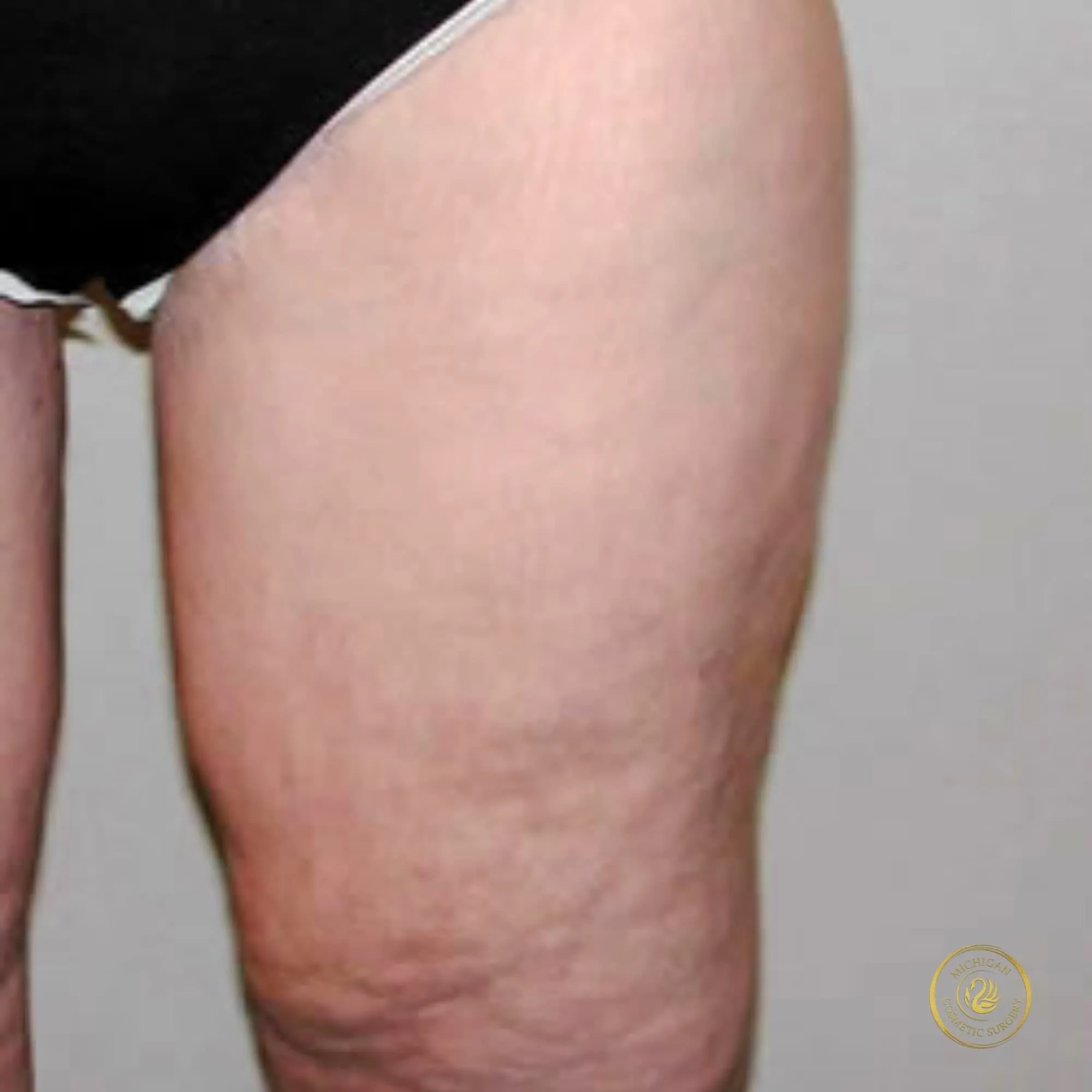 thigh lift after photo by michigan cosmetic surgery in southfield mi