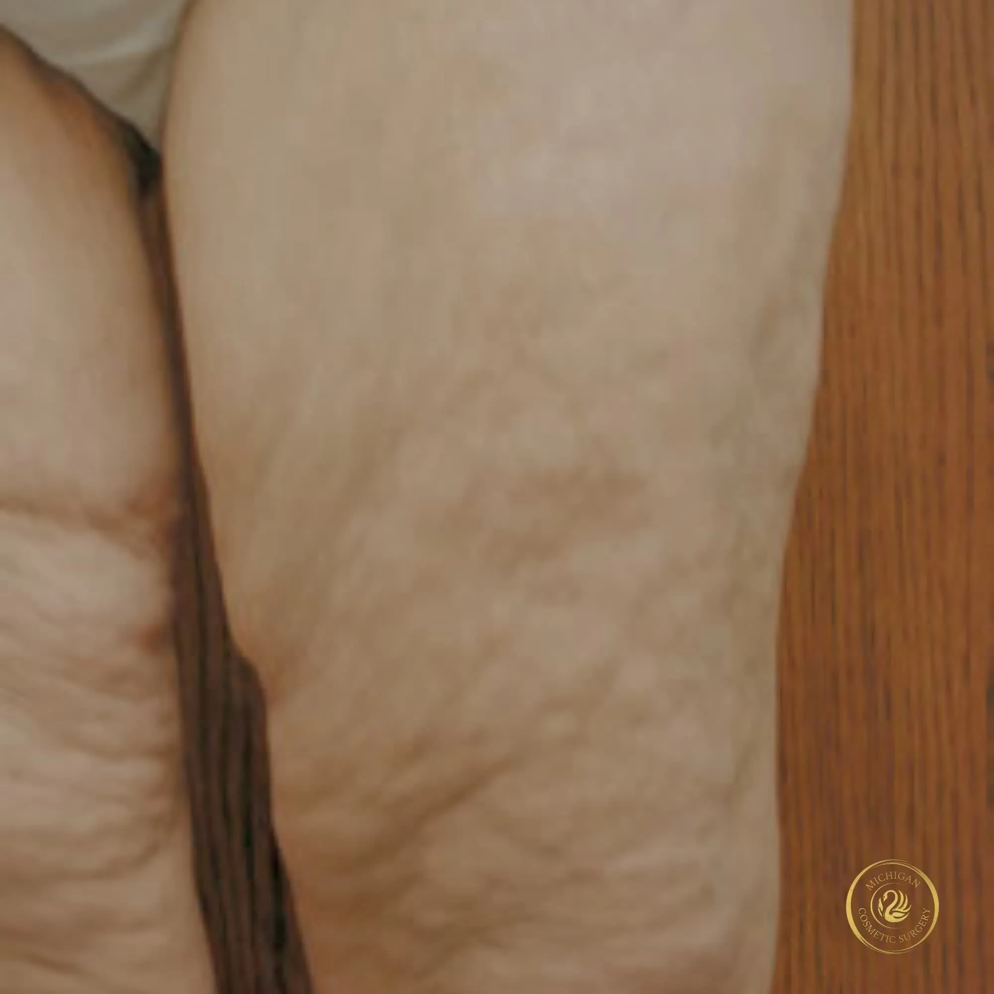 thigh lift before photo by michigan cosmetic surgery in southfield mi