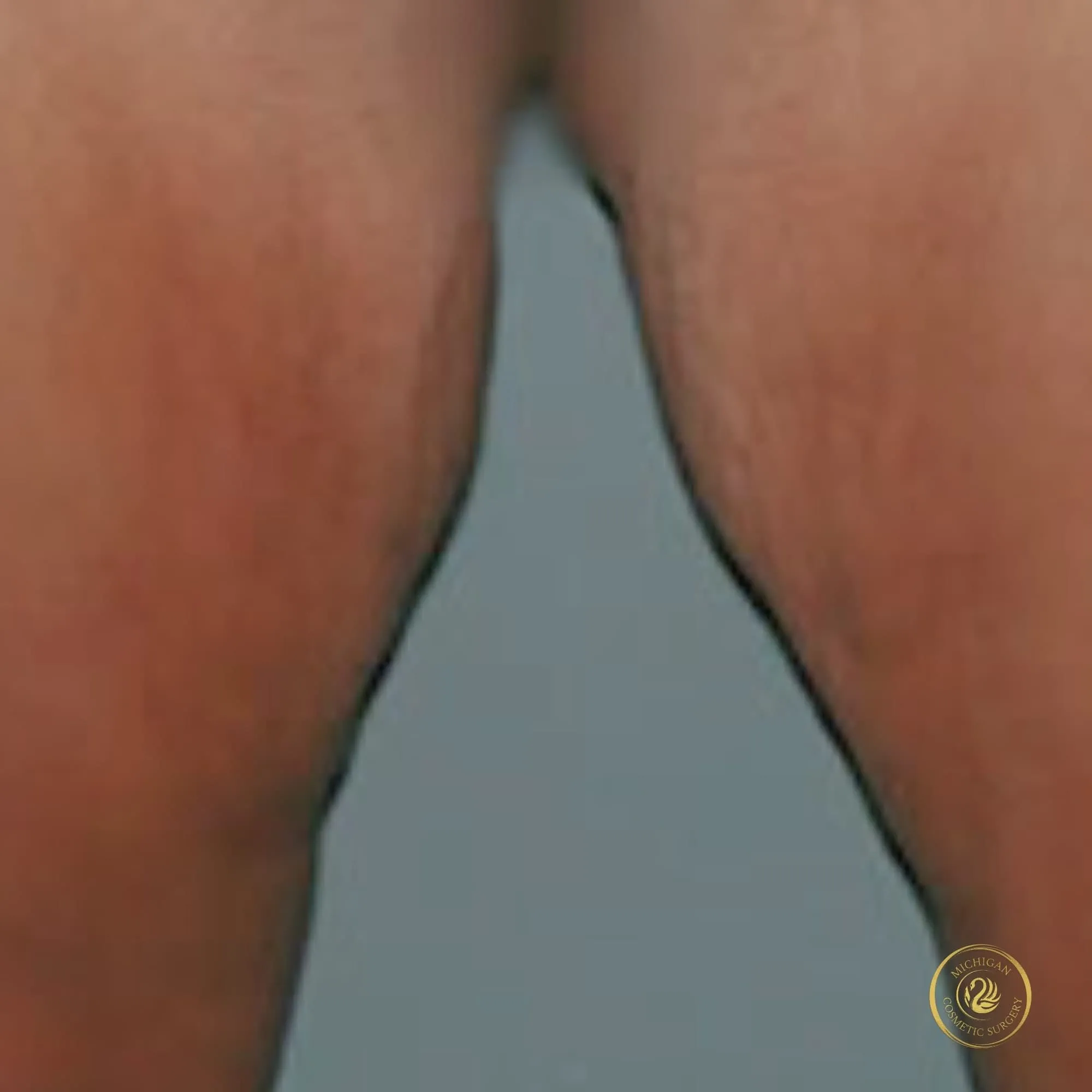 thigh lift after photo by michigan cosmetic surgery in southfield mi