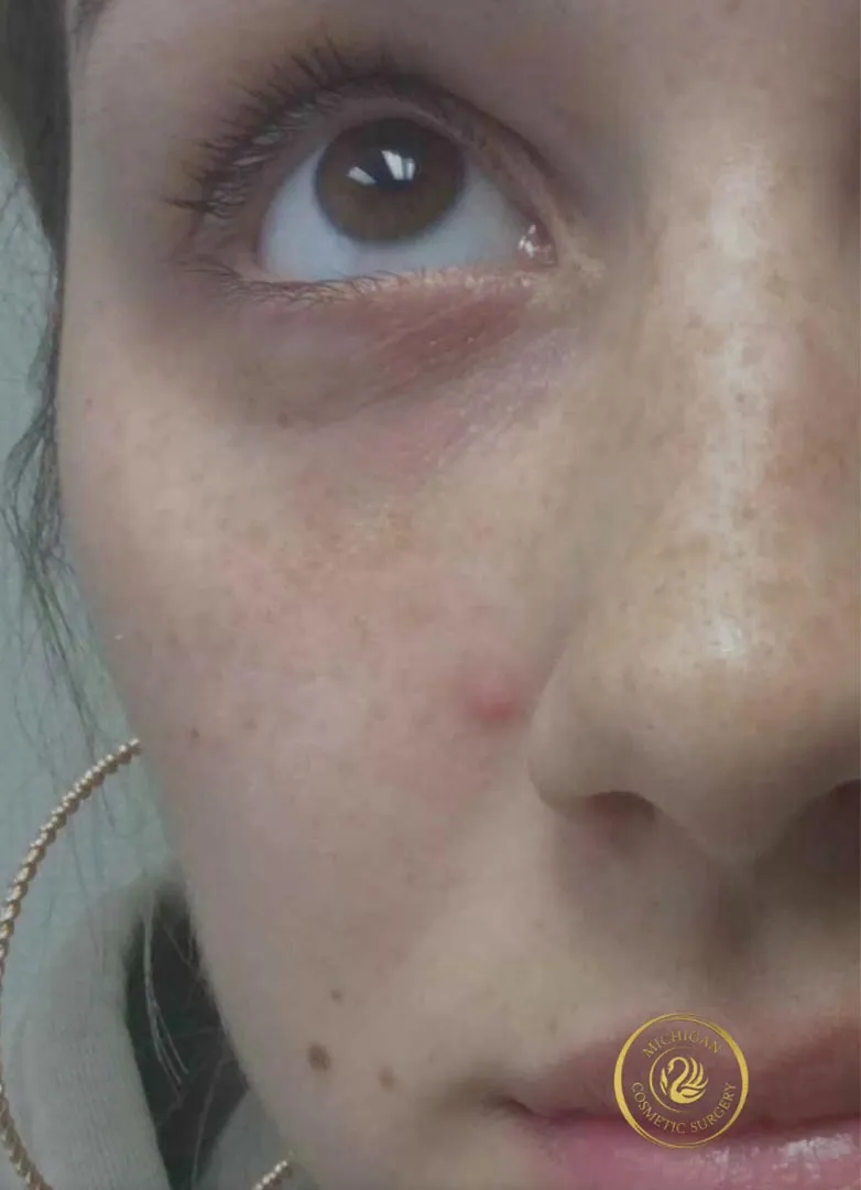 filler after photo by michigan cosmetic surgery in southfield mi