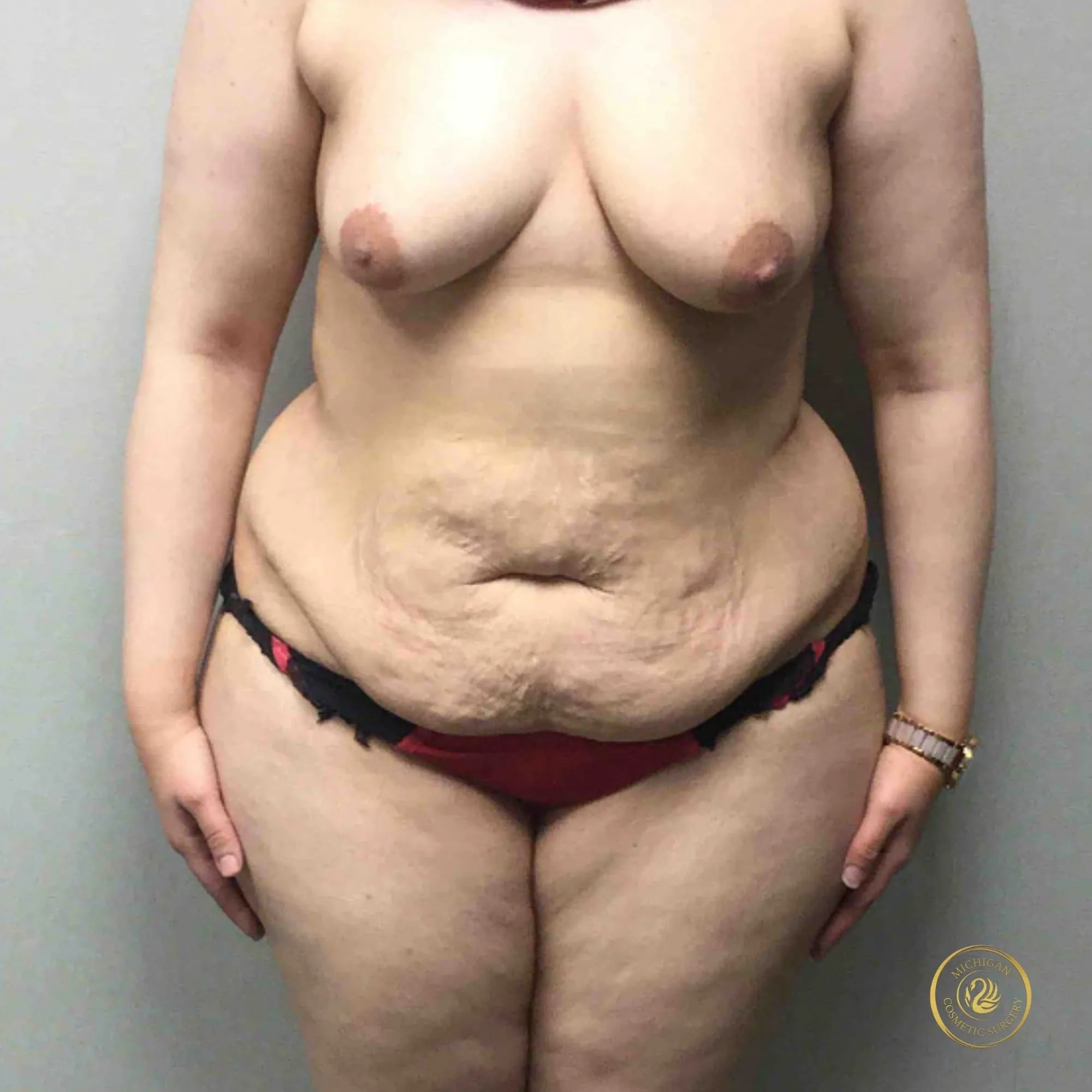 weight loss makeover before photo by michigan cosmetic surgery in southfield mi