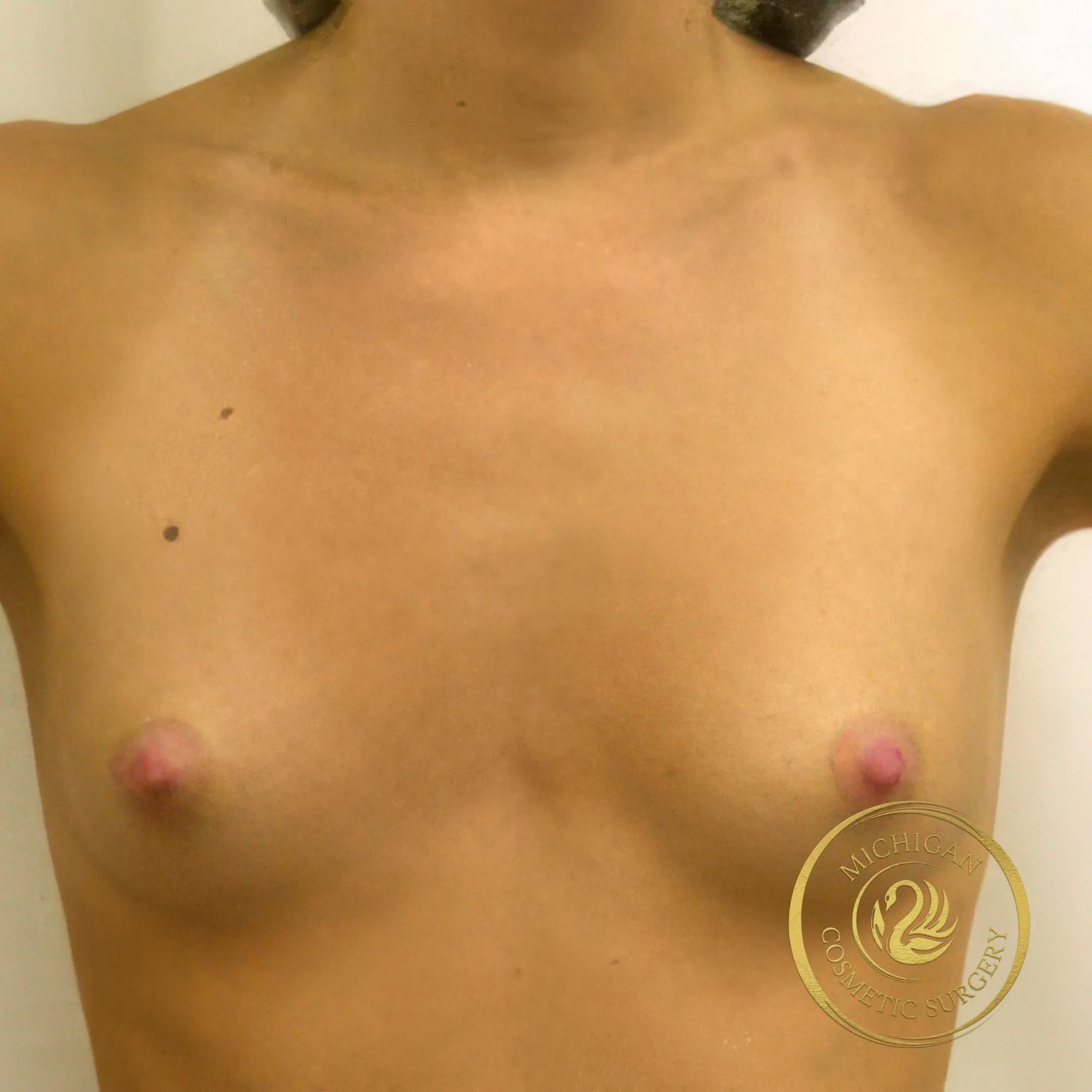 breast augmentation before photo by michigan cosmetic surgery in southfield mi