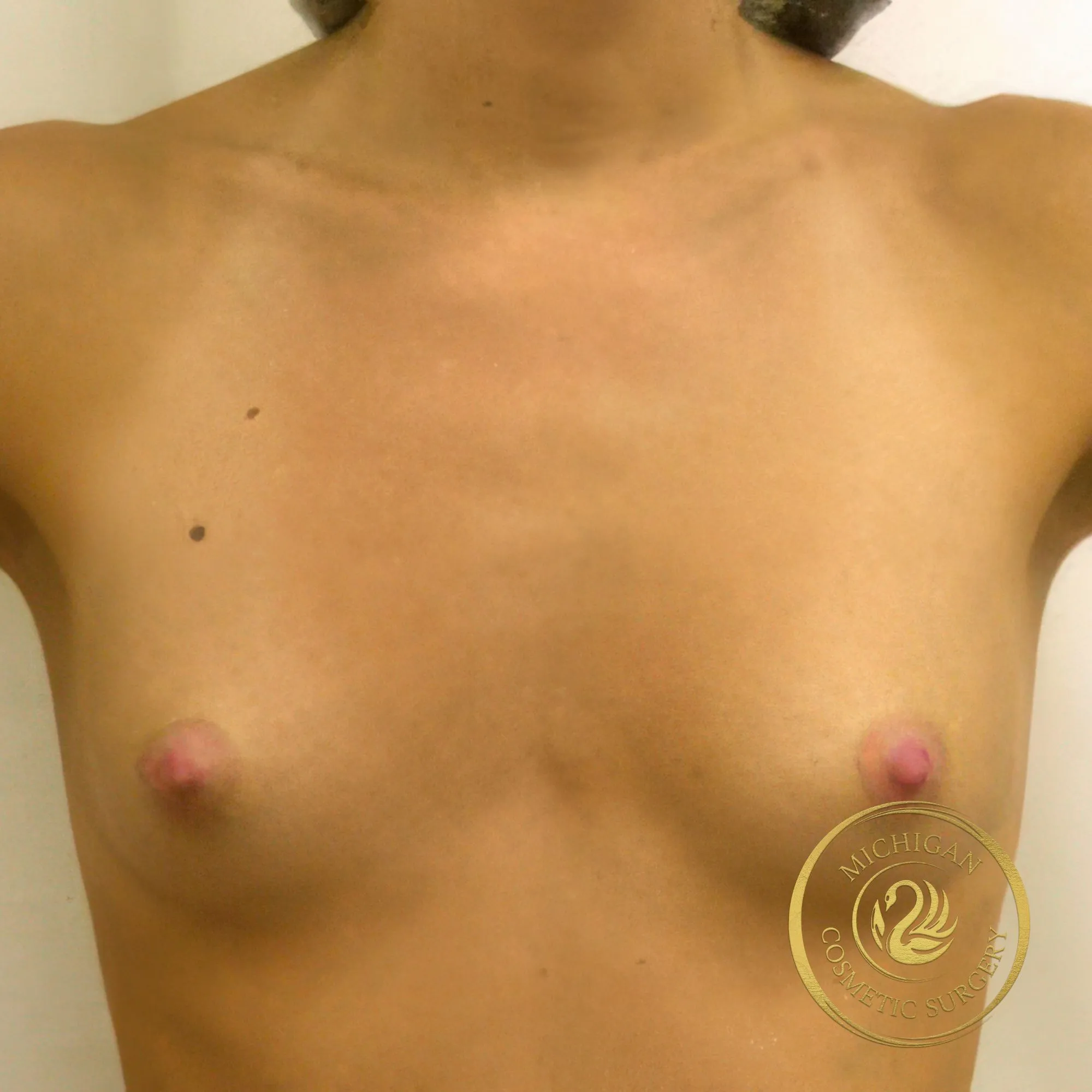 breast augmentation before photo by michigan cosmetic surgery in southfield mi