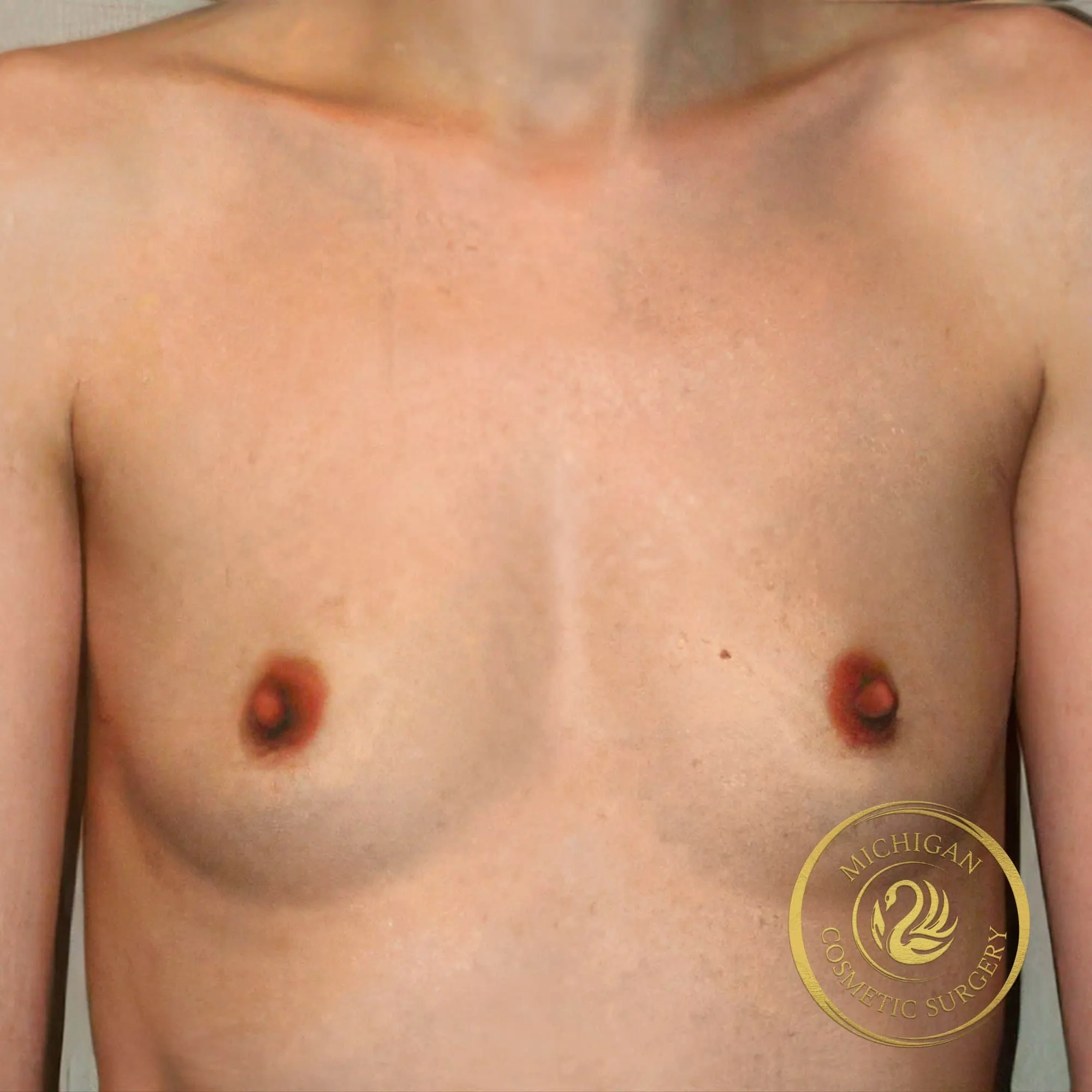 breast augmentation before photo by michigan cosmetic surgery in southfield mi