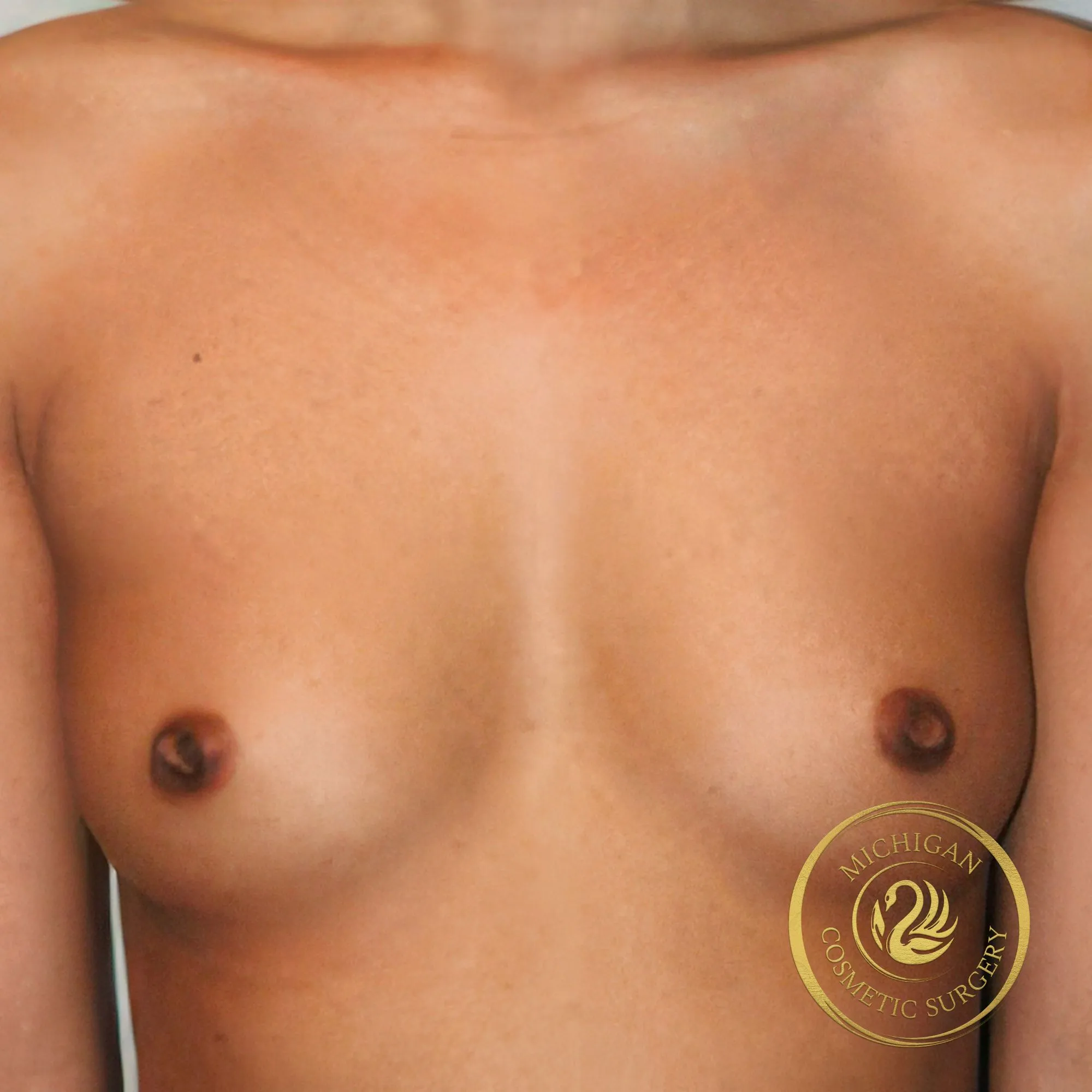 breast augmentation before photo by michigan cosmetic surgery in southfield mi